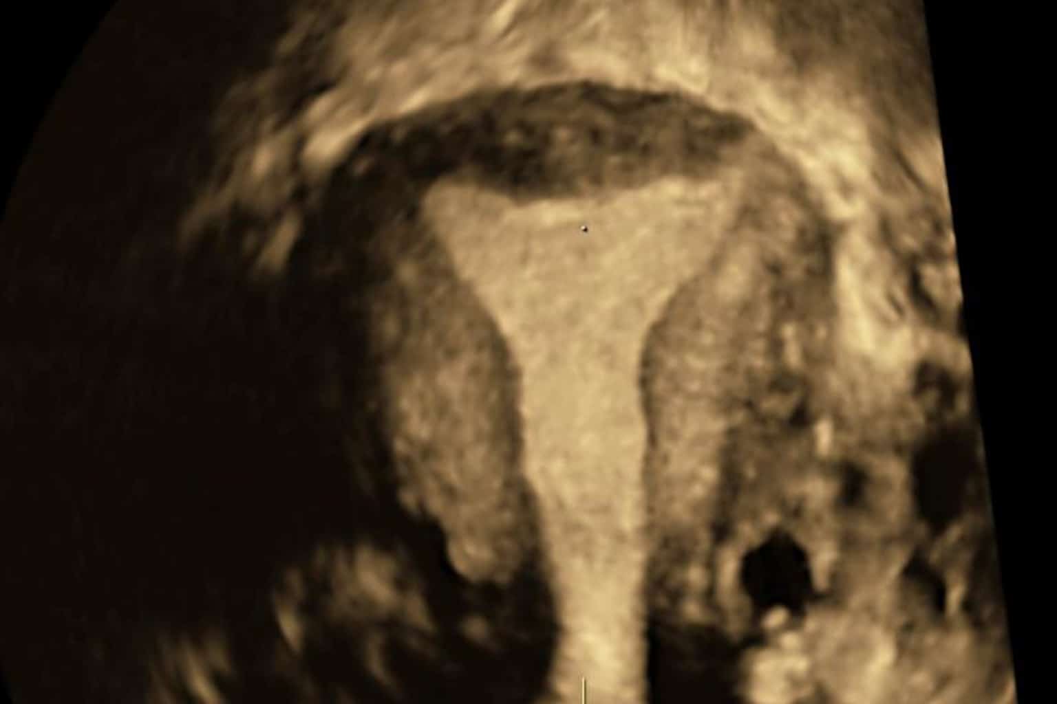 echographie pelvienne sage femme saint pierre en faucigny